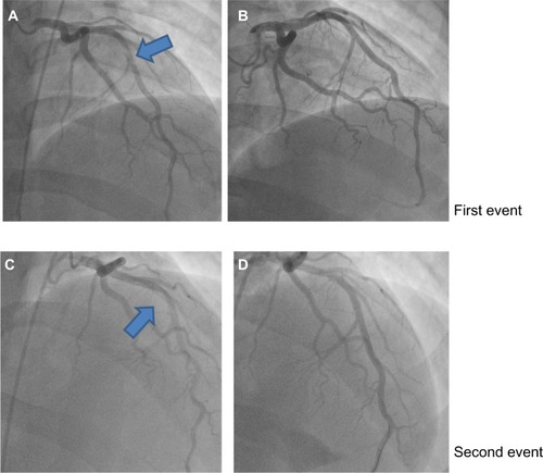 Figure 3 Left heart catheterization.