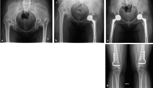 Figure 1. Case 1 with bilateral developmental dysplasia of the hip.a. Preoperativaelyb. Postoperatively, THA with 5.5 cm leg lengthening.c. Bilateral THAs.d. Healed bilateral distal femoral 3 cm shortening osteotomies.