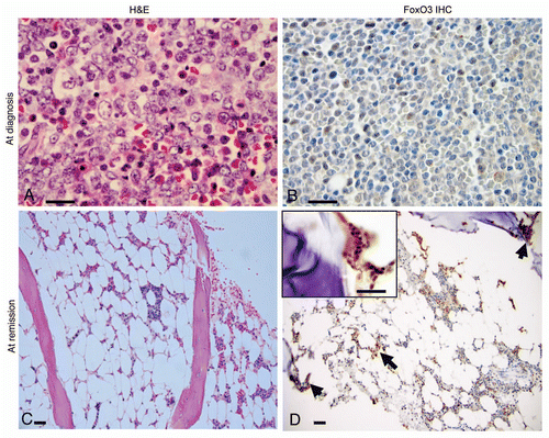 Figure 1 Bone marrow findings and FoxO3 expression in a Ph+ALL patient at diagnosis and after treatment with bortezomib. (A) H&E stained slide of a bone marrow trephine core biopsy at diagnosis revealed marrow space occupied by immature precursor B-lymphoblasts. Blasts (indicated by arrows; ∼90% of marrow cellularity) have an open chromatin, sparse cytoplasm and high N:C ratio. Rare scattered hematopoietic elements were present (x1,000). (B) FoxO3 immunostains (1:100; Millipore, Billerica, MA) revealed that most of these immature blasts lacked FoxO3 (magnification x1,000). (C) H&E slide of bone marrow core biopsy after treatment with bortezomib. The marrow was hypocellular for age (∼10% cellularity). It revealed only rare blasts along with normal hematopoietic elements (x100). (D) FoxO3 stains revealed that FoxO3 expression was seen in small clusters of cells within the interstitium (arrows; x100), including precursor cells localized to the endosteal niche (inset; x1,000). Reticle bar represents 100 µ.