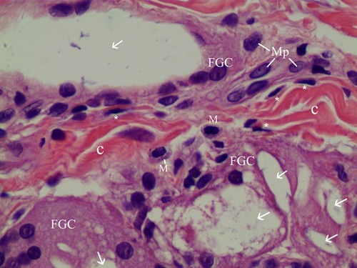 Figure 10 Mast cells and FGCs in 400× H&E staining. Two mast cells (M) were observed in the dermis, alongside three FGCs ingesting CaHA particles. CaHA particles (white arrow) were visible always in FGCs. Thick, irregularly arranged, fibroblast-produced reinforced collagen fibers (C) were seen between FGCs. Numerous fibroblasts (*) surrounded the matured collagen fibers (C).
