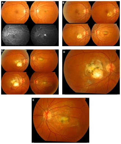 Figure 2 Case 2. (A) Active subfoveal CNV with active subretinal hemorrhage and subretinal fluid confirmed by intravenous fluorescein angiography that demonstrated classical subfoveal CNV with active leakage. In addition, there is evidence of angioid streaks emanating from the optic disc with evidence of peau d’orange fundus in both eyes. (B) Upper right active extrafoveal CNV OD. Upper left after laser treatment OD. Lower right enlargement of laser scar OD. Lower left active recurrent CNV OS. (C) Left column, new active CNV OD. Right column, active CNV OS. (D and E) Submacular fibrosis OU.