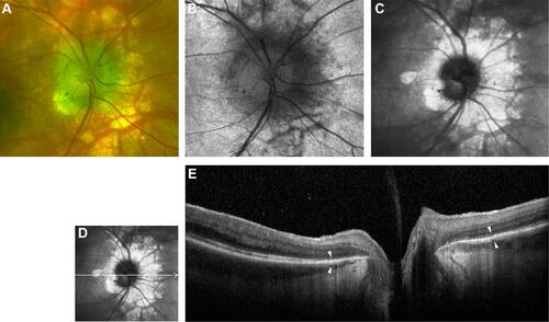 Figure 2 Optic nerve head of right eye of patient 3. (A) Color optic disc photo with peripapillary halo (PPH). (B) Fundus autofluorescence (FAF) of optic nerve head. (C) Red free image of the optic nerve head. (D and E) B-scan of swept-source optical coherence tomography (SS-OCT) image of PPH. White arrowheads point to the margins of RPE-Bruch’s membrane thinning.
