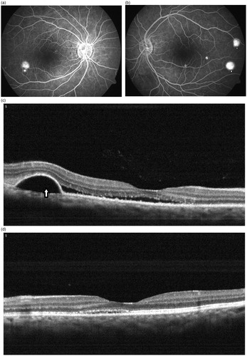 FIGURE 3. (a, b) Substantial angiographic resolution of smokestack leak (arrow) in right eye with persistence of PED leaks (arrowheads) in both eyes. (c, d) OCT scan of the right eye shows partial resolution of serous detachment of macula with persistence of PED (arrow) seen temporally and substantial resolution of serous detachment of macula seen in the left eye.