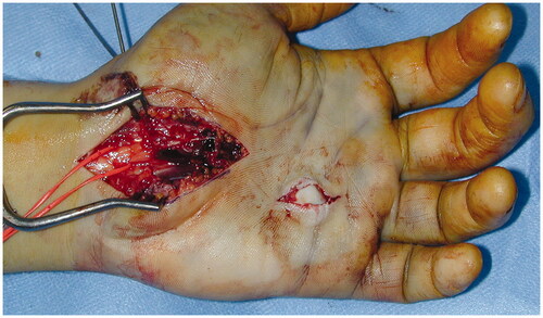 Figure 2. Intraoperative photograph of the migrated trapezoid fragment which caused the cutaneous laceration in the palm. After decompression the median nerve appears hemorrhagic, but in continuity.