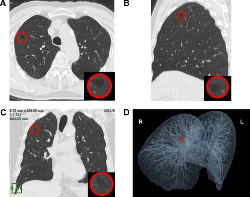 Figure 1 CT and 3D CT images of placement of a 2 cm diameter sphere in a lung.