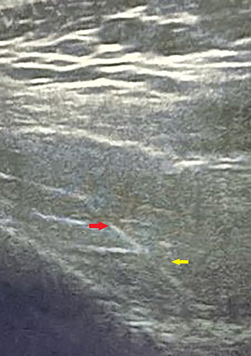 Figure 2 Ultrasound view of Interscalene block. (Needle (red arrow), Brachial plexus (yellow arrow).