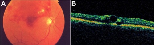 Figure 44 Branch retinal vein occlusion with macular edema.