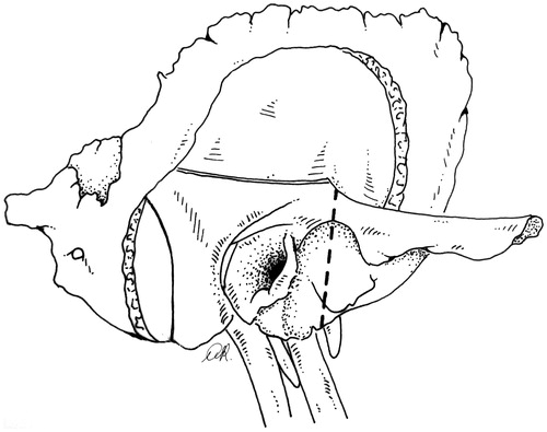 Figure 3. Right STBR. Lateral view: temporal and occipital craniotomies with exposure of the sigmoid-jugular bulb complex. The interrupted line indicates the lateral osteotomy.