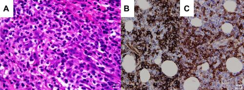 Figure 3 (A) Hematoxylin and eosin stain of the orbital mass revealed numerous blast cells with large round nuclei and prominent nucleoli. The immunohistochemical stain of the orbital mass showed positive expression of CD34 (B) and CD117 (C). (X400).