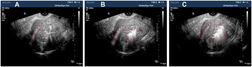 Figure 5. Transvaginal ultrasound images of the uterus. (A–C) Hyperechogenic signal under transvaginal ultrasound guidance indicates the ablation area, and the scope of the hyperechogenic signal becomes more and more larger. The red dots: the direction of the endometrium; the long arrow: the position of the ablation needle path; the short arrow: the position of the needle tip; the red circle: the range of ablation gasification and with the continuous progress of ablation, the range of strong echo gasification gradually increases.