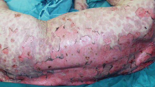 Figure 3. Detachment of large epidermal sheets in Stevens–Johnson syndrome/toxic epidermal necrolysis overlap; atypical target lesions are still present.