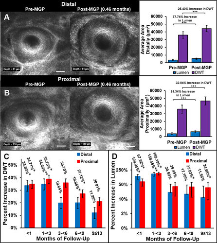 Figure 5 (A) Representative in vivo confocal microscopy (IVCM) images of an identical Meibomian gland at a depth of 81µm pre and post-Meibomian gland probing (MGP). This example is 0.46 months post-MGP. Statistical analysis revealed a significant 25.40% average increase in distal duct wall thickness (DWT) (purple) post-MGP (t(36)=5.035, p<0.001) and a significant 77.74% average increase in distal lumen area (blue) post-MGP (t(36)=5.035, p<0.001). (B) Representative IVCM images of the same identical Meibomian gland as “A” at a depth of 110µm pre and post-MGP. Statistical analysis revealed a significant 32.04% average increase in proximal DWT (purple) post-MGP (t(30)=4.597, p<0.001) and a significant 81.34% average increase in proximal lumen area (blue) post-MGP (t(30)=4.597, p<0.001). (C) Average percent increase in distal (blue) and proximal (red) DWT post-MGP over time (months). When compared to baseline, glands with a less than 1 month, 1 month or greater and less than 3 months, 3 months or greater and less than 6 months, 6 months or greater and less than 9 months, 9 months or greater and less than or equal to 13 months follow-up had an average increase in distal DWT of 33.59% (n=9, p=0.015), 34.60% (n=9, p=0.008), 19.64% (n=4, p=0.068), 19.86% (n=7, p= 0.028) and 11.89% (n=7, p=0.063), respectively, and an average increase in proximal DWT of 34.71% (n=9, p=0.011), 38.75% (n=8, p=0.012), 35.70% (n=2, p=0.180), 27.12% (n=6, p=0.028), and 20.91% (n=5, p=0.080), respectively. (D) Average percent increase in distal (blue) and proximal (red) lumen area post-MGP over time (months). When compared to baseline, glands with a less than 1 month, 1 month or greater and less than 3 months, 3 months or greater and less than 6 months, 6 months or greater and less than 9 months, 9 months or greater and less than or equal to 13 months follow-up had an increase in distal lumen area of 120.95% (n=9, p=0.011), 158.56% (n=9, p=0.008), 20.59% (n=4, p=0.273), 17.10% (n=7, p=0.128), and 11.56% (n=7, p=0.237), respectively, and an increase in proximal lumen area of 67.52% (n=9, p=0.021), 169.19% (n=8, p=0.017), 39.49% (n=2, p=0.180), 37.83% (n=6, p=0.028), and 34.68% (n=5, p=0.043), respectively. Scale bar, 50µm. (*p<0.05, **p<0.01, ***p<0.001).