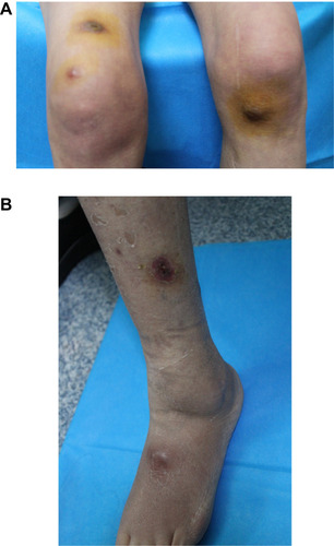 Figure 2 Scattered nodules on both knees (A) and the left lower limb (B).