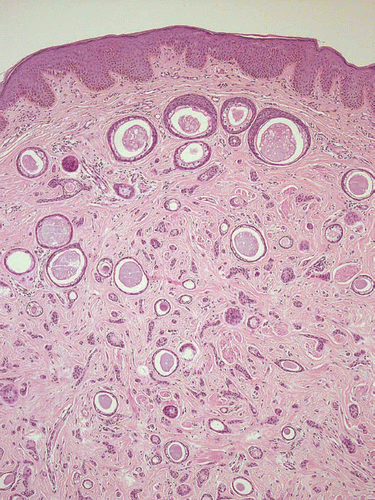 Figure 2 Extensive syringoma located in the vulva, causing severe pruritus (patient #2), H&E, ×100