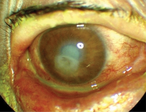 Figure 2 The color photograph shows the corneal perforation, cataractous lens, the lower ectropion, shallow anterior chamber, and conjunctival congestion in the right eye.