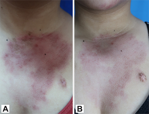 Figure 4 Comparison between skin manifestation on the chest before (A) and after four sessions of PDL treatment (B).