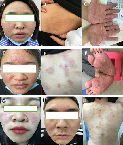 Figure 1 Clinical pictures: (A–I) Follicular papules with a diameter of about 1–2 mm are seen based on erythema on the face and trunk and expand eccentrically to the periphery in a circular or creeping pattern, and pustules are seen in some patients.