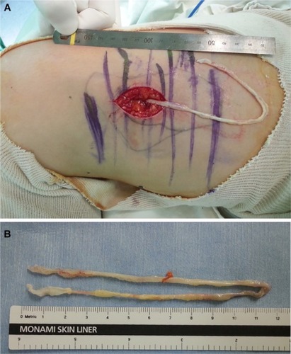 Figure 3 (A and B) Total surgical excision was performed.