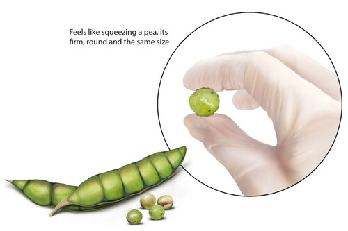 Figure 5. Detection: ‘Feels directly attached to the skin and the patient does not complain about pain’. For the purpose of explanation, the illustration encompasses a visual clue analogy of a pea to bring about viewer engagement and to exemplify the need for palpation during detection of BU lumps under the skin. The pea was chosen to be representative of a local variety grown within Ghana, called the Pigeon pea (Cajanus cajan). This reflects the senses of touch/sensation and sight. Illustration by Joanna Butler.