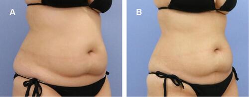 Figure 7 (A) Baseline; (B) 3 months after abdominal treatment with a circumference change above navel of −6 cm.