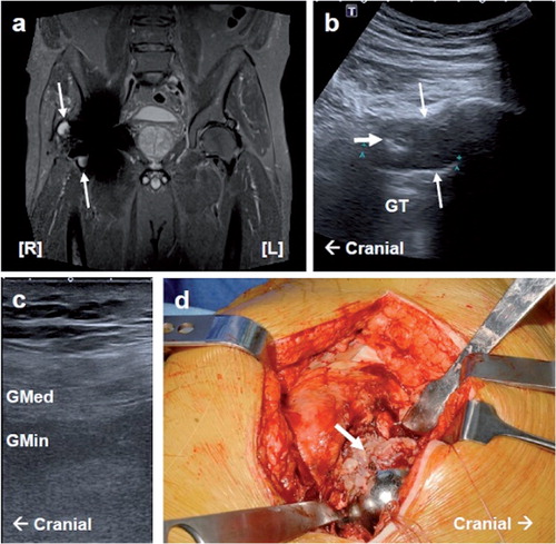 Figure 1. Case 1. MARS MRI, ultrasound, and intraoperative images of a pseudotumor and gluteal muscle atrophy. a. A coronal STIR sequence MARS MRI section showing a right anterior (type-IIa) and lateral (type-IIb) pseudotumor (white arrows). In addition, right-sided fatty atrophy of the gluteus medius and minimus muscles (grade 3) can be seen. b. Lateral longitudinal USS showing a large cystic pseudotumor (type 2) with a thickened wall and upper solid focal region (thick white arrow). c. Lateral longitudinal USS of the right gluteus medius and minimus muscle showing fatty atrophy (reported as grade 2). d. Photograph taken during revision surgery showing a florid inflammatory reaction to the right hip neocapsule (thick white arrow).GT: greater trochanter; Gmed: gluteus medius; Gmin: gluteus minimus. Pathology is indicated by white arrows.
