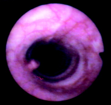 Figure 5. Endoscopic view of a small-sized, intraluminal tracheal mass (eosinophilic granuloma) 45 days after surgical excision of a pre-existing mass. The location of the relapsed mass was approximately 1–2 cm caudal to the anastomosis.