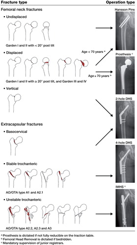 The algorithm for hip fracture surgery.