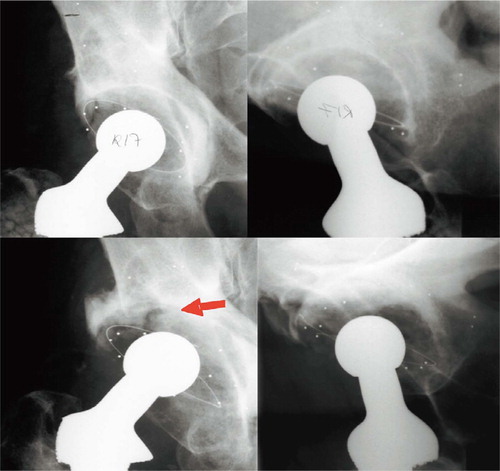 Figure 2. Acetabular revision in a 78-year-old man operated with impaction grafting mixed with OP-1, and a cemented Reflection cup.Upper left and right: postoperative AP and lateral views.After 5 years (lower left and right) the graft had disappeared proximally and medially (see lateral view), the cement mantle had fractured (arrow), and the metallic indicator had loosened and become deformed.The center of the socket migrated 4.8 mm laterally and 4.2 mm proximally.At revision, the cup was found to be loose and the proximal graft bed had resorbed. Distal to the cement fracture, the cement mantle was fixed to the graft bed, which seemed to have integrated into the underlying host bone.