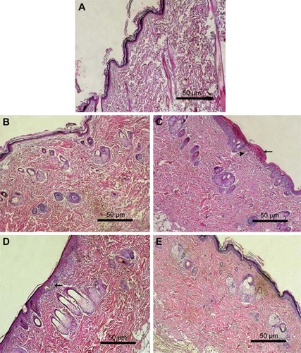 Figure 10 Photomicrographs of histopathologic examination of skin irritation after topical application of different gel formulations for 7 days.Notes: (A) Control rat skin, (B) plain gel, (C) zarotex gel, (D) Act gel, and (E) Act niosomal gel. H&E (100×). Photomicrograph of skin treated with zarotex gel showed necrosis of the epidermis with crust formation of the overlying superficial layer (arrow) and dilated blood capillaries in the underlying dermis (arrowhead). Photomicrograph of skin treated with Act gel exhibited degenerative changes of the prickle cell layer and status spongiosus formation (arrow) with normal dermis and skin appendages.Abbreviation: Act, Acitretin.