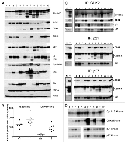 Figure 1 LMW cyclin E overexpression and cyclin E kinase activity in bladder cell lines. (A) Western blot analysis of cyclin E, Cdk2, Cdk4, Cdk6, p27, p21, p16, cyclin D1, p53, Rb, PCNA and actin in bladder cell extracts. (B) Comparison of full-length (FL) and LMW cyclin E protein levels in non-tumorigenic (NT) and tumorigenic (T) bladder cell lines. Mean values ± SEM for NT and T, respectively, were 125.0 ± 15.8 and 176.3 ± 16.8 (p = 0.063) for FL cyclin E and 24.6 ± 3.8 and 90.2 ± 11.6 (p = 0.001) for LMW cyclin E. (C) Immune complexes of Cdk2, p21 and p27 in cell extracts were immunoprecipitated (IP) with polyclonal antibodies to Cdk2, p21 and p27 coupled to protein A-coated beads. Immune complexes were then subjected to western blot (WB) analysis using antibodies to cyclin E, Cdk2, p21 and p27. Normal mammary epithelial cells (N) and breast cancer cells (T) were used as standards. (D) Kinase assays were performed on cell extracts by immunoprecipitation with monoclonal antibodies to cyclin E coupled to protein G-coated beads or polyclonal antibodies to Cdk2, p21 and p27 coupled to protein A-coated beads. Histone H1 was used as the substrate. Lane designations correspond to sample numbers given in Table 1.