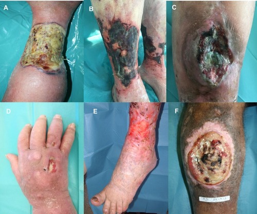 Figure 1 (A) Pyoderma gangrenosum (Inflammatory ulcer), (B) Calciphylaxis (Vasculopathy), (C) Adamantinoma (Neoplastic ulcer), (D) Mycobatteriosis (Infectious ulcer), (E) Hydroxyurea-induced ulcer (F) Heroin induced ulcer.