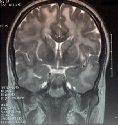 Figure 3 Magnetic resonance imaging scan of the brain (coronal section) showing hyperintensities involving white matter.