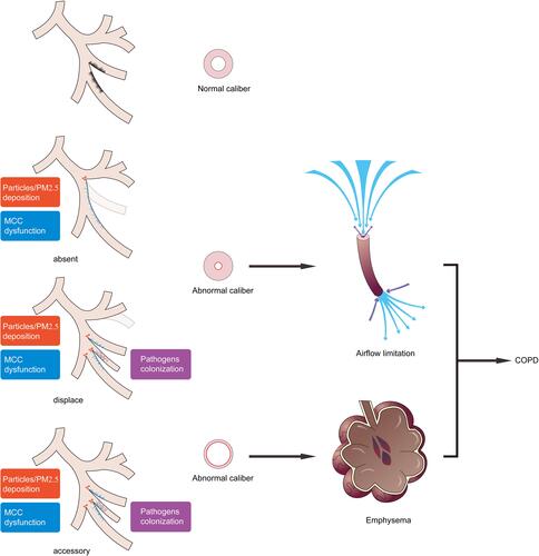 Figure 3 Schematic representation of bronchial variations in the development of COPD. Bronchial variations participate in the pathogenesis of COPD as anatomical determinants and promote abnormal bifurcations with more particles deposition. Abnormal variant bronchus covered cilia with movement and distribution dysfunction (MCC dysfunction) allowed more pathogens colonization. Absent or displaced bronchial variation presents bronchial wall thickening and caliber shorter, resulting in airflow limitation. Accessory or displaced bronchial variation accompanied by bronchial wall thinning and lumen enlargement results in emphysema. These are two common pathophysiological development patterns of COPD.