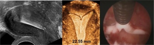 Figure 10 2-D/3-D ultrasonography: Another example of position of the stem of the Nova-T intrauterine device (IUD), showing slight downward displacement (left). The arms of the IUD are unfolded and penetrate the cornua of the uterus (middle, 3-D; right, hysteroscopy picture).