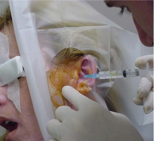 Figure 2 Temporomandibular joint injection.