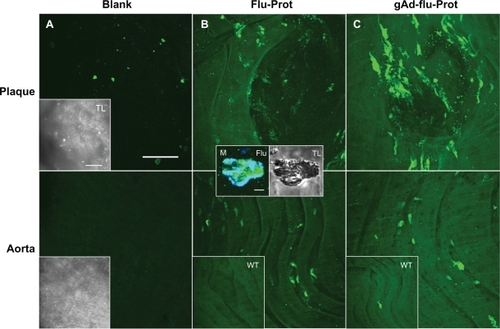 Figure 4 The staining signal of globular adiponectin at atherosclerotic plaques is altered by protamine-oligonucleotide-based nanoparticles. Aortic sections of apolipoprotein E-deficient and C57Bl6/J wild type mice were incubated with Alexa Fluor 488-labeled proticles for control (B), or with gAd-coupled, Alexa Fluor 488-labeled proticles (C). Blank sections are shown in (A). The upper panels correspond to plaque regions, while the lower panels show the signals in artery sections without plaques. The inserts (B, C) show the weak fluorescence signals from stained wild type aortas. Transmitted light images of the aortic sections are shown in (A) (inserts). The inserts in (B) show the accumulation of proticles (green signal) inside a CD68-verified macrophage (M, blue signal). Both bars in (A) indicate 50 μm, bar in the first insert in (B) indicates 5 μm.Abbreviation: gAd, globular domain of adiponectin.