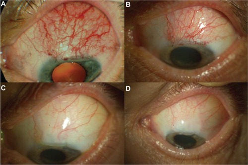 Figure 1 Successful treatment of early bleb failure with topical bevacizumab in patient 3. (A) Flat and injected bleb prior to bevacizumab application, (B) 7 days after topical administration of bevacizumab, (C) 2 months after topical administration of bevacizumab, and (D) 6 months after topical administration of bevacizumab, revealing a pale, elevated, and functional bleb.