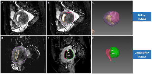 Figure 4. 3D reconstruction of MRI before and after ablation in a case of diffuse adenomyosis with unilateral myometrium involved (type IV). A 44 year-old woman who presented with HMB, had diffuse adenomyosis with the posterior myometrium involved (type IV) (A). 3D reconstruction of pre-ablation MRI showed that the volume of uterine corpus, adenomyotic lesion and endometrium was 180.2 ml, 44.5 ml, and 7.9 ml, and the baseline ISA of EMJ was 36 cm2 (B,C). Post-ablation MRI showed obvious decrease of the SI of the endometrium (D), and no perfusion was observed on the ipsilateral EMJ (arrows) (E). 3D map after treatment showed slight overlap between ablation zone and EMJ (arrows) (F). The NPVr reached 85.7%, and the ablation rate of EMJ was 14.6%. During the follow-up, this patient had PR at 3 months, NR at 6 and 12 months after treatment.