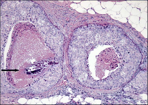 Figure 2.  DCIS. High nuclear grade and necrosis with centrally located coarse microcalcification (→) (Haematoxylin/Eosin).