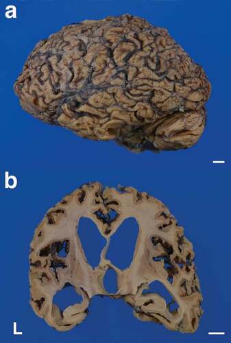 Figure 1. Macroscopic appearances of the formalin-fixed brain. (a) Severe cerebral atrophy with widening of the sulci is recognized from the frontal to the occipital lobes. The cerebellum also shows severe atrophy. (b) Coronal section of the cerebrum shows severe thinning of the neocortex. Severe enlargement of the lateral and third ventricles is also apparent, but the hippocampal formation is relatively preserved from atrophy. The striatum, medial thalamus, and white matter also show atrophy. The corpus callosum is extremely thin. Scale bars: 10 mm. L, left side