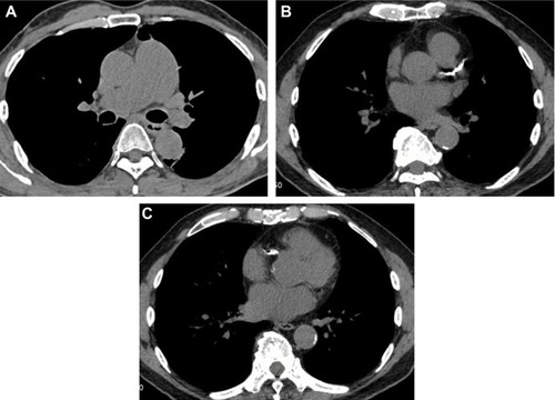 Figure 6 Axial CT images with a mediastinal-window setting showing a dilated main pulmonary artery (A) and calcifications of the aorta and coronary arteries (B–C).