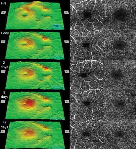 Figure 1 Sequential retinal surface maps (left) and the optical coherence tomography angiography images showing the foveal avascular zone in the superficial (center) and deep (right) plexuses at each visit pre- and postoperatively.