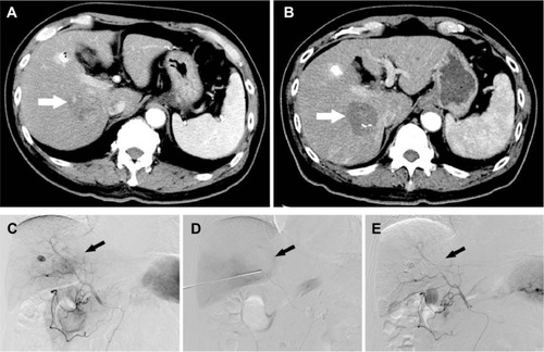 Figure 1 A 75-year-old man who presented with CRLM treated with MWA combined with synchronous TACE.