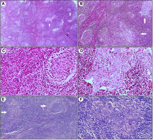 Figure 1 Numerous hyperplastic lymphoid follicle-like nodules are distributed in a disordered manner. For Case #1, in the background of hyperplastic lymphoid follicles, the weakly-stained area (arrow) was surrounded by lymphocytes, mimicking germinal centers (A, 40×; B, 100×). Abundant plasma cells are evident in the interfollicular area (C, 200×). The pleomorphic carcinoma cells were large, lightly stained, and contained large nuclei and prominent nucleoli (D, 400×). A similar pattern was observed in Case #2. The weakly-stained carcinoma cells (arrow) were distributed in the middle of the follicles, similar to the germinal centers (E, 200×; F, 400×).