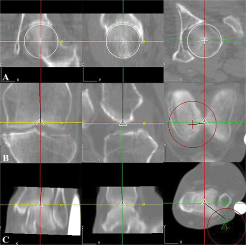 Figure 3. To obtain a 3D image, the whole leg was scanned from the femoral head through the knee joint to the ankle joint. However, preoperative planning with ORTHODOC requires only three volumes: the femoral head (A), the knee joint (B), and the ankle joint (C).