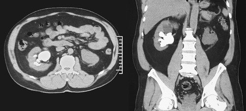 Figure 1 CT scan showed right complete staghorn stone with left proximal ureteral stone.