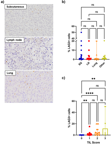 Figure 2. Association between LAG-3 expression, sites of disease and TILs.