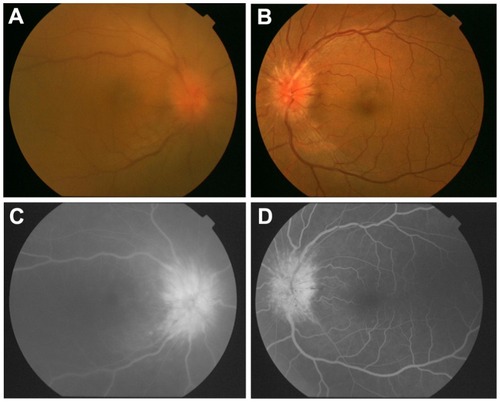 Figure 1 Fundus photographs and fluorescein angiograms for case 1 with sarcoidosis. (A and B) Fundus photographs of right and left eye at initial examination. Diffuse vitreous opacities can be seen in the right eye and optic neuritis in both eyes. (C and D) Fluorescein angiograms showing dye leakage from the optic discs of both eyes. (A and C), right eye, (B and D) left eye.