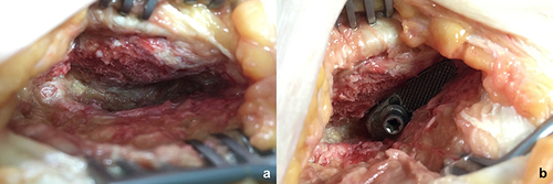 Figure 8 (a) The canyon-like recess is prepared to receive (b) the patient-specific implant, which is shaped to ensure a large titanium-bone interface.