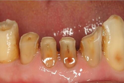 Figure 2 Severe wear of lower anterior teeth.